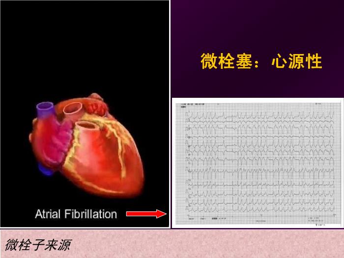 【醫學PPT課件】短暫性腦缺血發作  北京航天總醫院神經內科第10頁