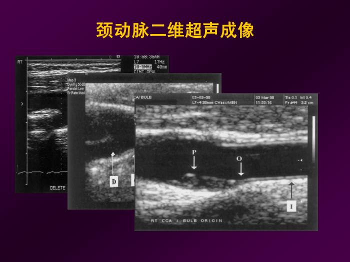 【醫學PPT課件】短暫性腦缺血發作  北京航天總醫院神經內科第15頁