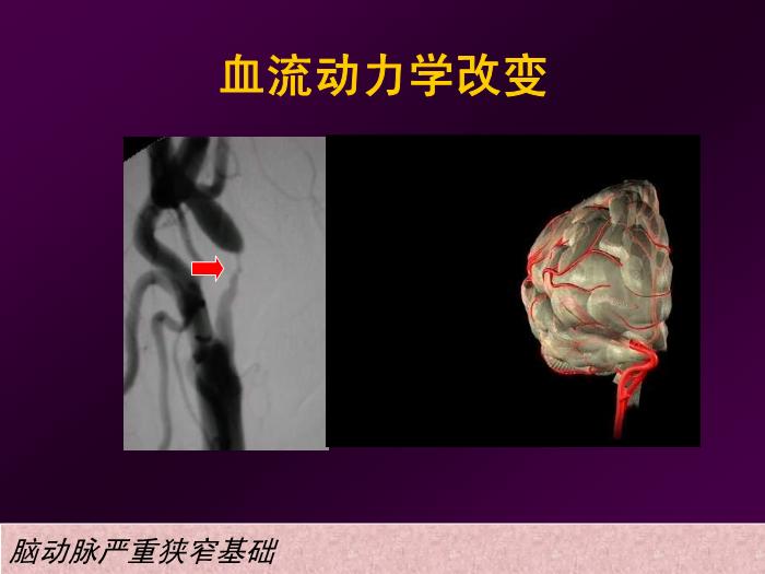 【醫學PPT課件】短暫性腦缺血發作  北京航天總醫院神經內科第8頁