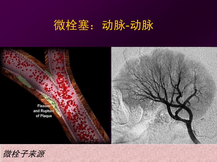 【醫學PPT課件】短暫性腦缺血發作  北京航天總醫院神經內科第9頁