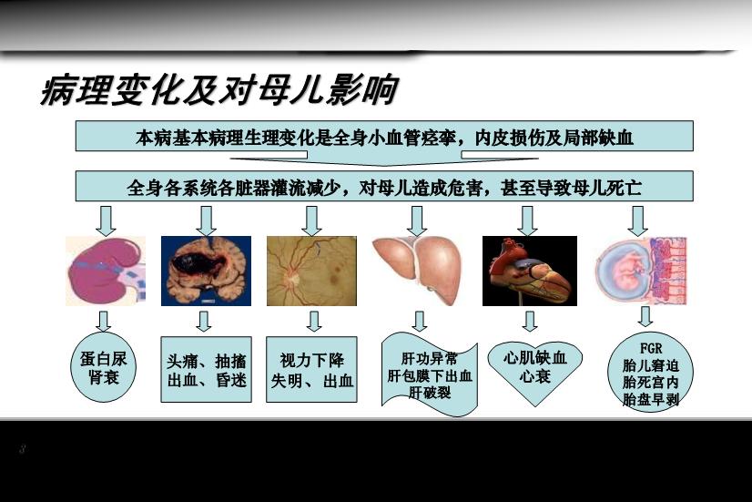 【醫學PPT課件】妊娠期高血壓疾病 人衛版教學PPT課件第8頁