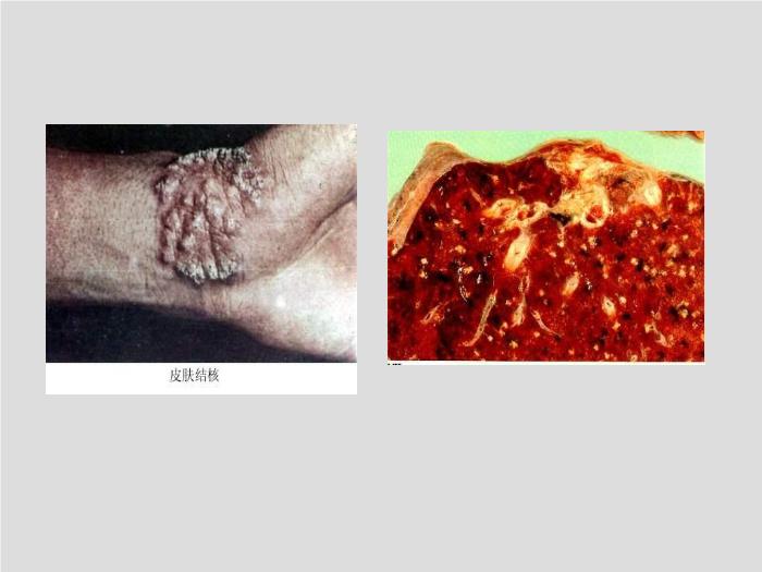 【醫學PPT課件】第14章 分枝桿菌、放線菌與諾卡菌  河北醫科大學第6頁