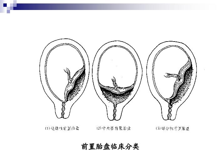 【醫學PPT課件】前置胎盤復旦大學精品課件第10頁