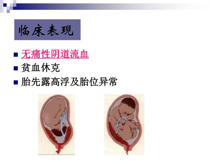 【醫學PPT課件】前置胎盤復旦大學精品課件第11頁