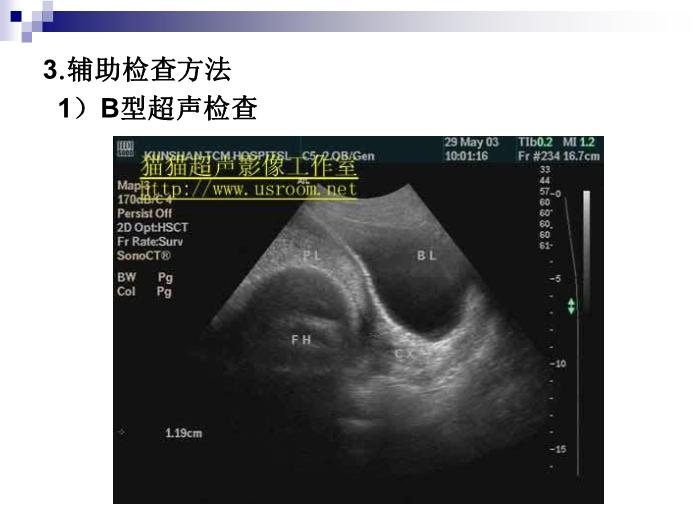 【醫學PPT課件】前置胎盤復旦大學精品課件第13頁