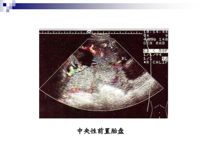 【醫學PPT課件】前置胎盤復旦大學精品課件第14頁