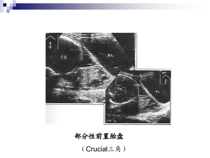 【醫學PPT課件】前置胎盤復旦大學精品課件第15頁