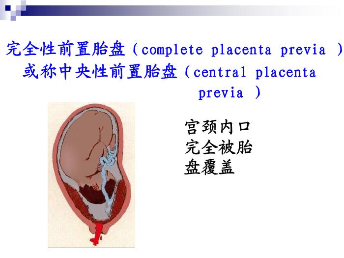 【醫學PPT課件】前置胎盤復旦大學精品課件第7頁