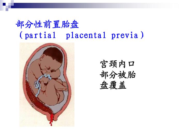 【醫學PPT課件】前置胎盤復旦大學精品課件第8頁