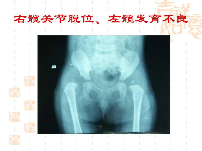 【醫學PPT課件】發育性髖關節脫位-浙江大學醫學院附屬兒童醫院第10頁