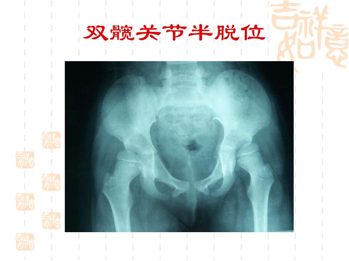 【醫學PPT課件】發育性髖關節脫位-浙江大學醫學院附屬兒童醫院第11頁