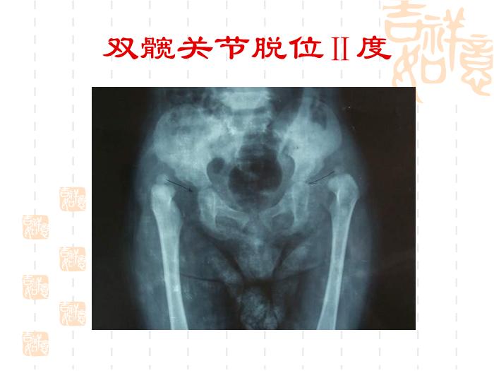 【醫學PPT課件】發育性髖關節脫位-浙江大學醫學院附屬兒童醫院第12頁