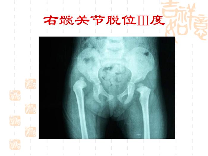 【醫學PPT課件】發育性髖關節脫位-浙江大學醫學院附屬兒童醫院第13頁