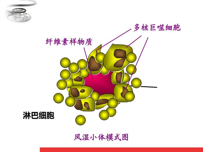 【醫學PPT課件】風濕熱 八年制兒科學PPT課件第15頁