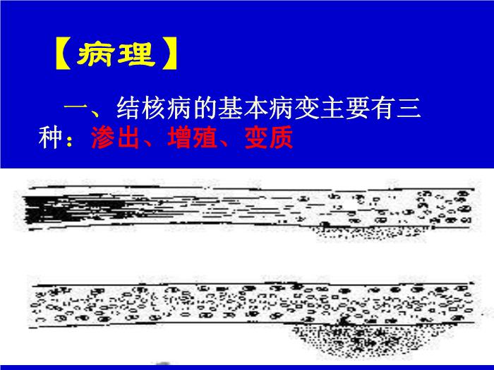 【醫學PPT課件】肺結核 pulmonary tuberculosis(TB)河南醫科大學一附院呼吸內科 王靜第7頁