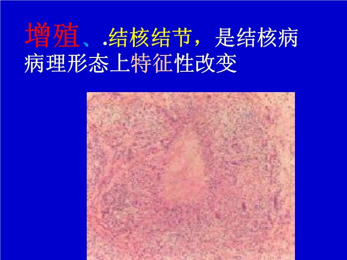 【醫學PPT課件】肺結核 pulmonary tuberculosis(TB)河南醫科大學一附院呼吸內科 王靜第8頁