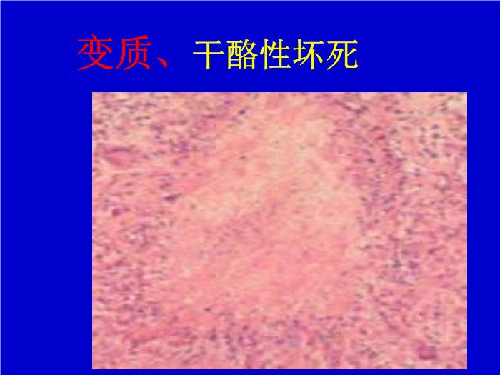 【醫學PPT課件】肺結核 pulmonary tuberculosis(TB)河南醫科大學一附院呼吸內科 王靜第9頁
