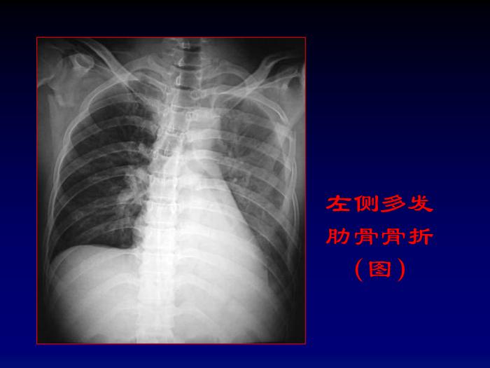 【醫學PPT課件】肺部外傷影像診斷_PPT課件第7頁