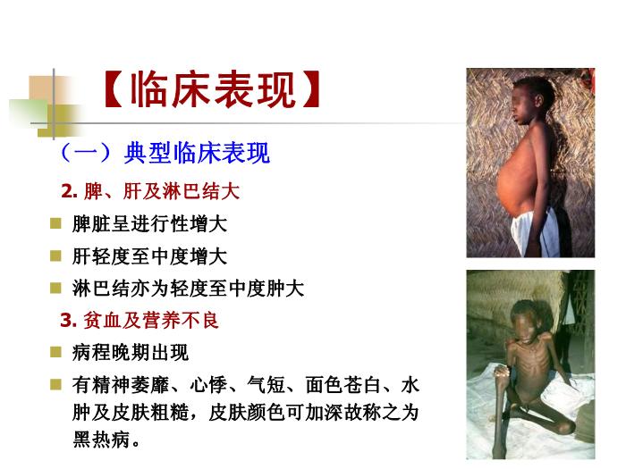 【醫學PPT課件】黑熱病 西安交通大學傳染病學教學課件第12頁