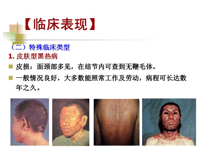 【醫學PPT課件】黑熱病 西安交通大學傳染病學教學課件第13頁