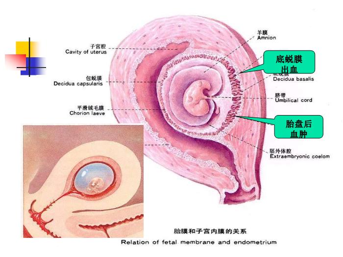 【醫學PPT課件】流產abortion(課件)第12頁
