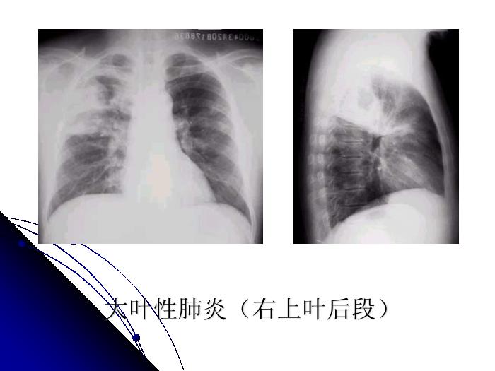 【醫學PPT課件】肺部炎癥影像診斷_南大一附院影像科PPT課件第12頁