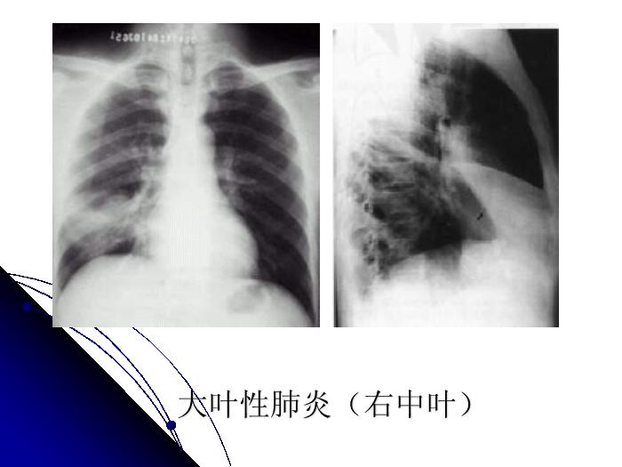【醫學PPT課件】肺部炎癥影像診斷_南大一附院影像科PPT課件第13頁