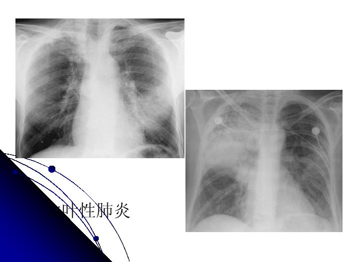 【醫學PPT課件】肺部炎癥影像診斷_南大一附院影像科PPT課件第15頁