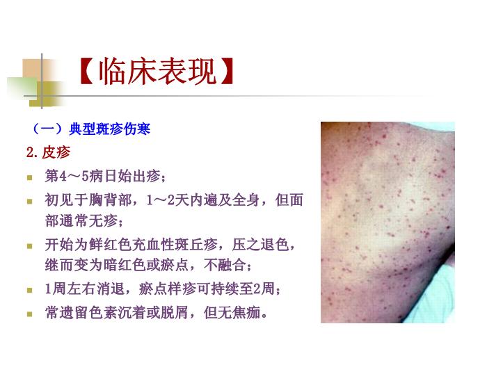 【醫學PPT課件】流行性與地方性斑疹傷寒 西安交通大學傳染病學教學課件第15頁
