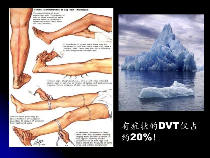 【醫學PPT課件】婦科圍手術期血栓栓塞性并發癥的診斷和防治第14頁