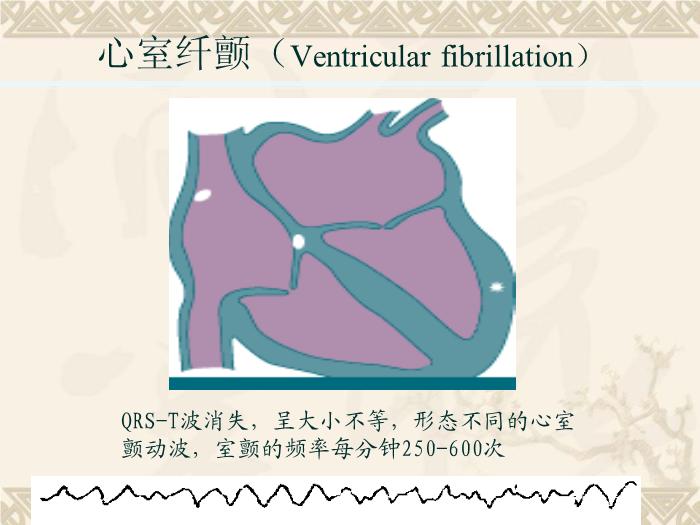 【醫學PPT課件】抗心律失常藥-藥理學教研室第10頁