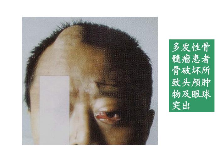 【醫學PPT課件】第25章_免疫增殖性疾病及其免疫檢第14頁