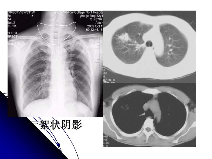 【醫學PPT課件】肺結核影像診斷_南大一附院影像科PPT課件第14頁