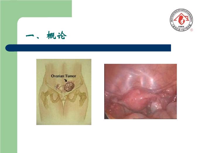【醫學PPT課件】卵巢腫瘤  復旦大學附屬婦產科醫院預覽圖（2）
