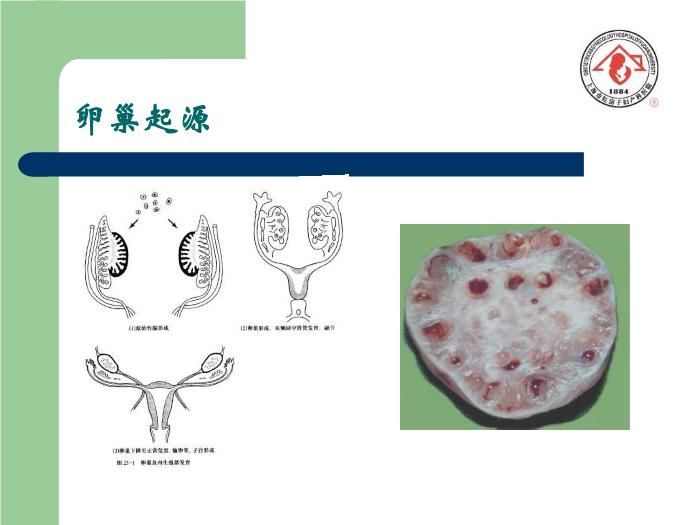 【醫學PPT課件】卵巢腫瘤  復旦大學附屬婦產科醫院預覽圖（4）