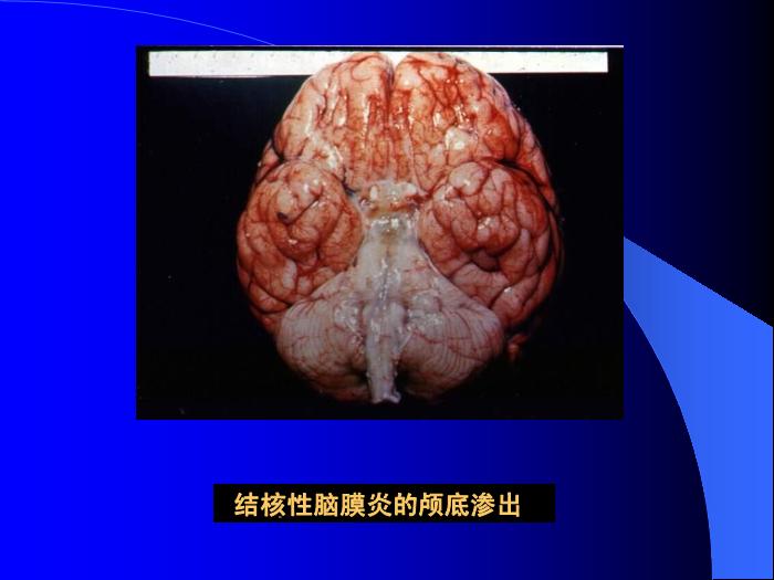 【醫學PPT課件】結核性腦膜炎2 PPT（幻燈片） 2第5頁