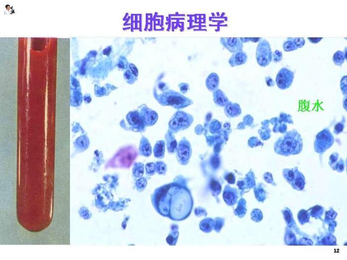 【醫學PPT課件】骨腫瘤病理知識  煤炭總醫院病理科楊連君第12頁