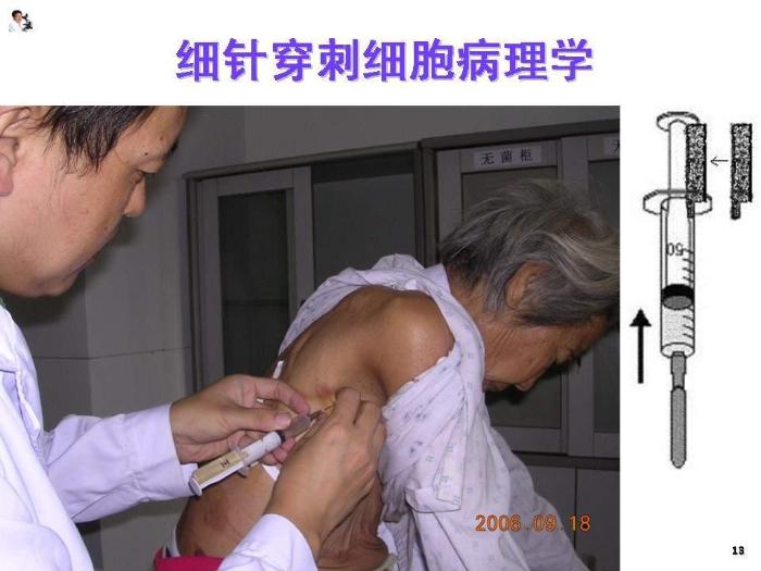 【醫學PPT課件】骨腫瘤病理知識  煤炭總醫院病理科楊連君第13頁