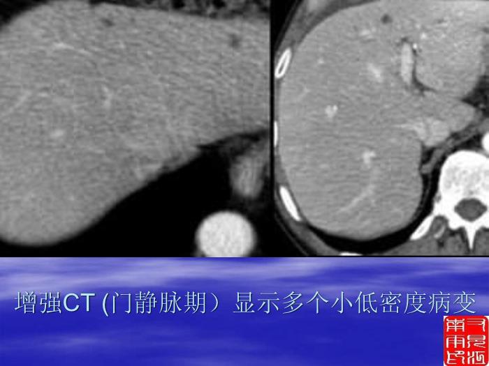 【醫學PPT課件】第四部分：肝臟偶發腫瘤的影像診斷_PPT課件第5頁