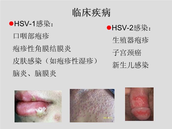 【醫學PPT課件】第27章 皰疹病毒 浙江大學附屬第一醫院陳瑜第6頁