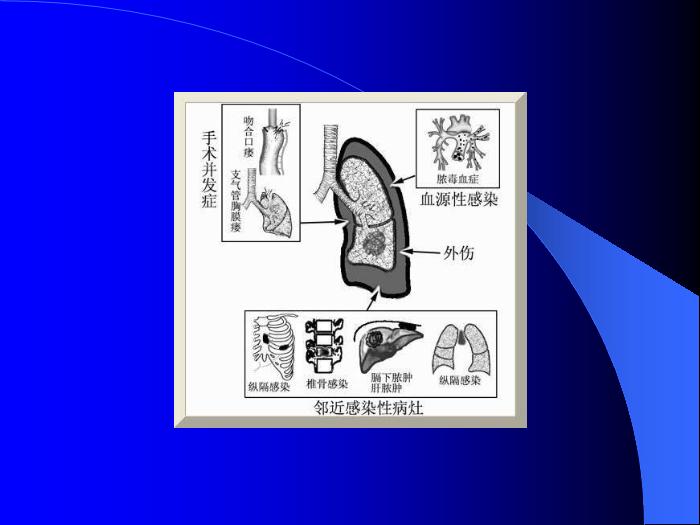 【醫學PPT課件】第29章 膿胸  蚌醫附院胸心外科第5頁