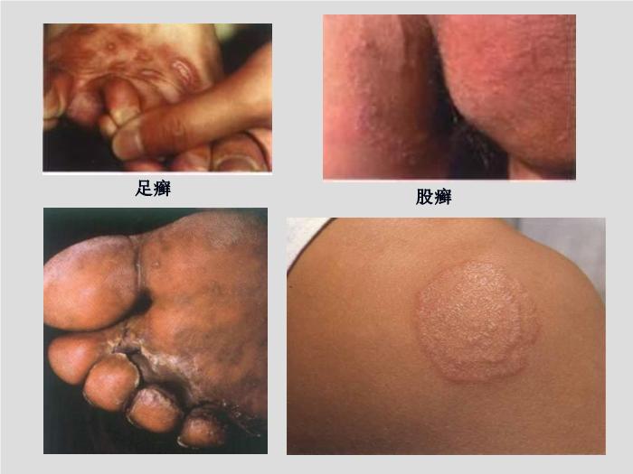 【醫學PPT課件】第21章 引起皮膚和軟組織感染的真菌