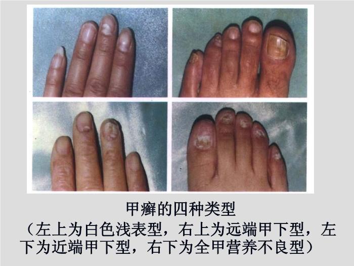 【醫學PPT課件】第21章 引起皮膚和軟組織感染的真菌