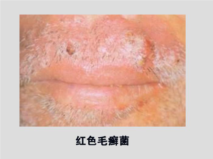 【醫學PPT課件】第21章 引起皮膚和軟組織感染的真菌