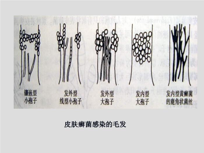 【醫學PPT課件】第21章 引起皮膚和軟組織感染的真菌