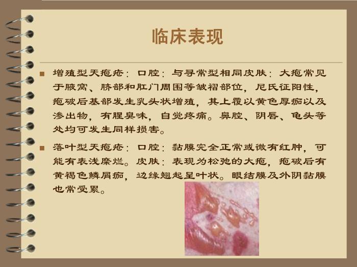 【醫學PPT課件】護理查房—天皰瘡 風濕內科陳省英第8頁