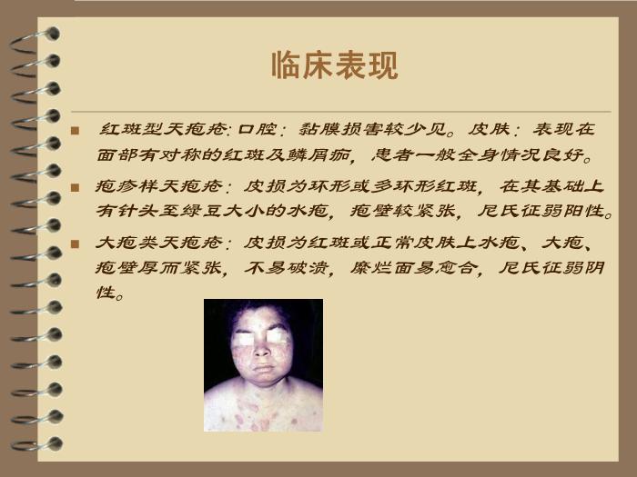 【醫學PPT課件】護理查房—天皰瘡 風濕內科陳省英第9頁