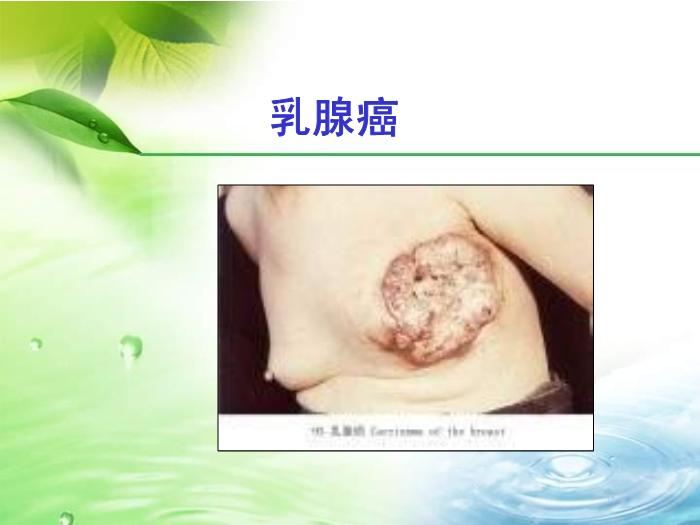 【醫學PPT課件】健康生活遠離癌癥-中華社區衛生服務中心第10頁