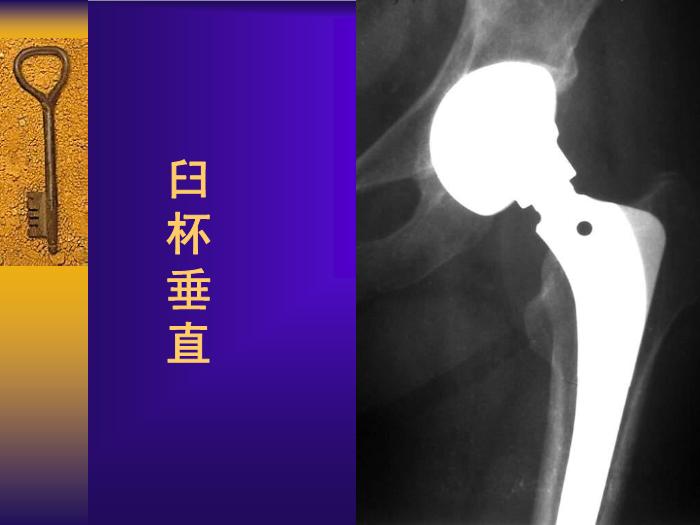 【醫學PPT課件】全髖關節置換手術的常見失誤及其預防第10頁