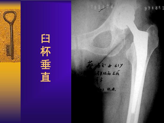 【醫學PPT課件】全髖關節置換手術的常見失誤及其預防第11頁